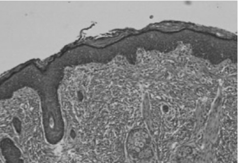 Hairy polyp of the oropharynx: a report of two cases and literature review