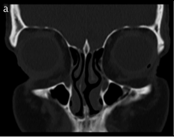Is an increase in the depth of the olfactory fossa caused by excessive vertical facial growth? A radiological study
